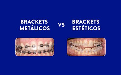 brackets esteticos vs metalicos|brackets precio.